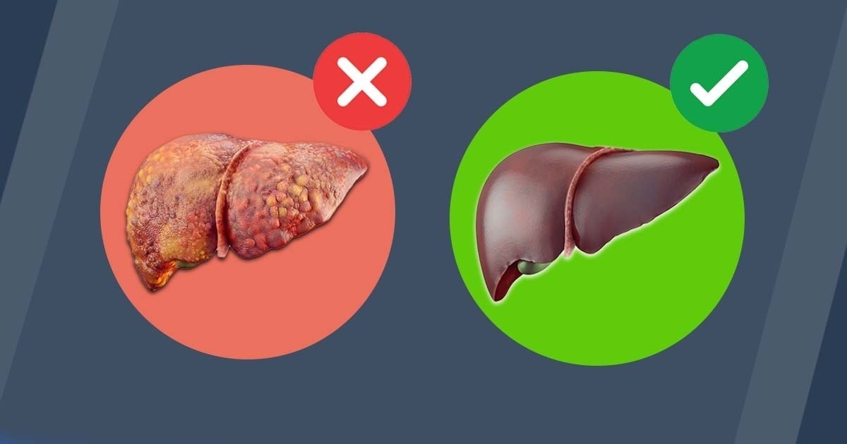 Limpieza del hígado: así es como te librarás de la grasa abdominal