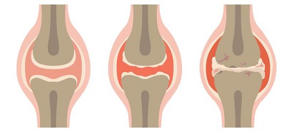 Los síntomas de la osteoartritis